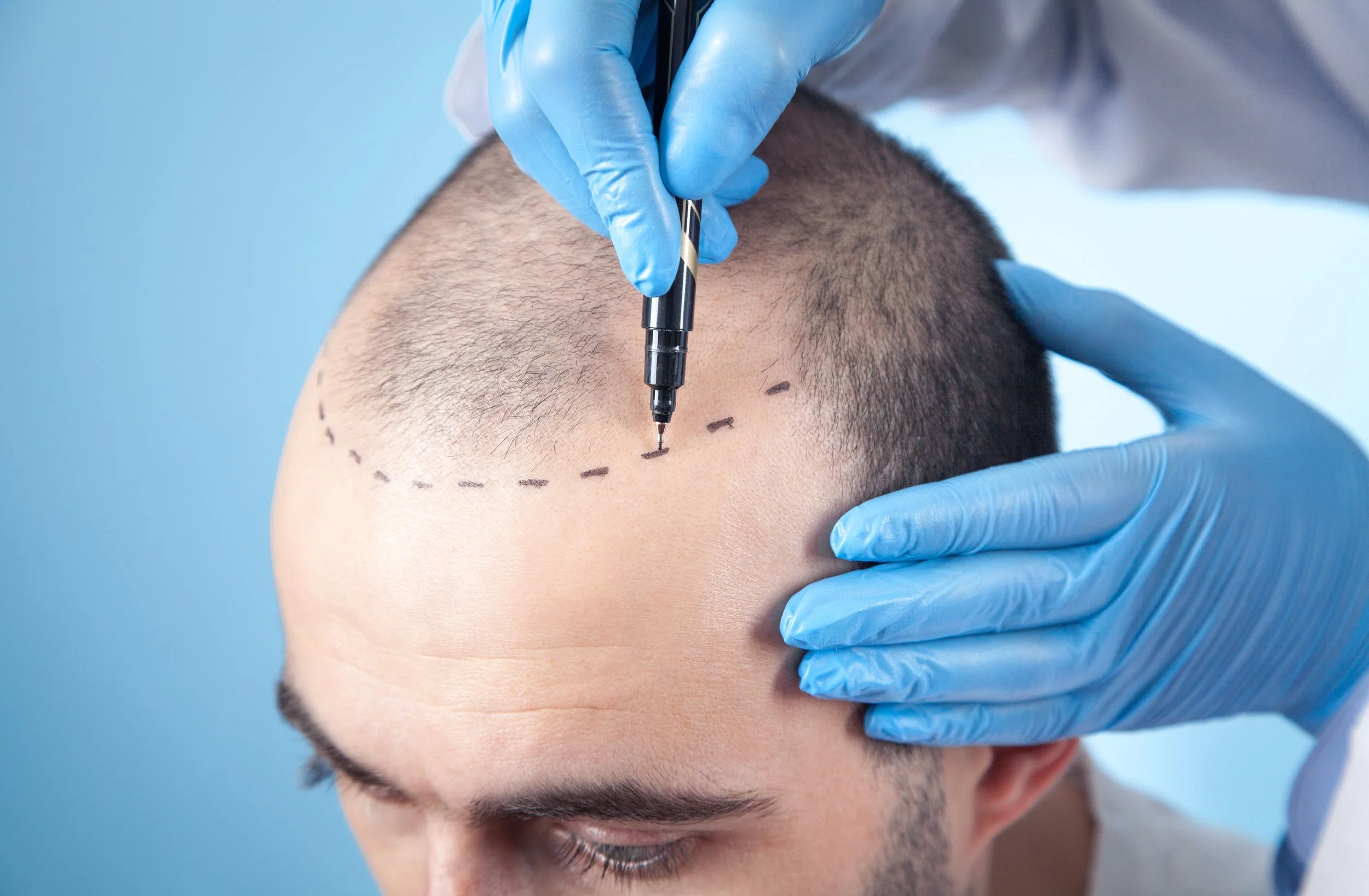 Hair+Transplant+Timeline+-+Hairline