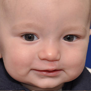 بعد-جراحی-شکاف-کام