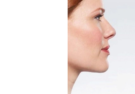 بعد-جراحی-غبغب