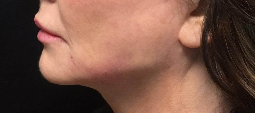 بعد-زاویه-سازی-صورت2