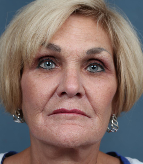 بعد-لیفت-صورت2