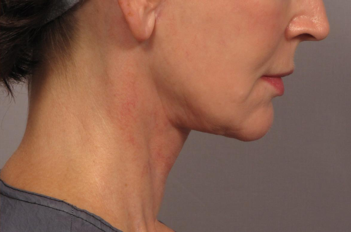 بعد-لیفت-گردن