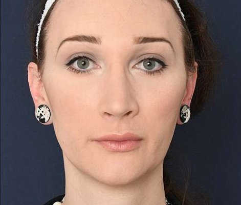 بعد-کوچک-کردن-چانه