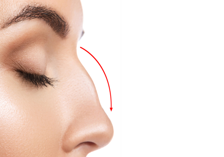 قبل-از-جراحی-بینی