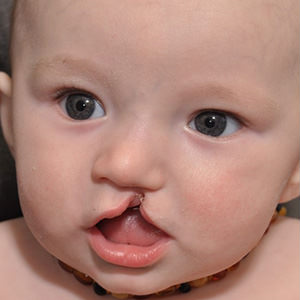 قبل-جراحی-شکاف-کام