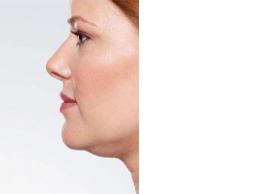 قبل-جراحی-غبغب