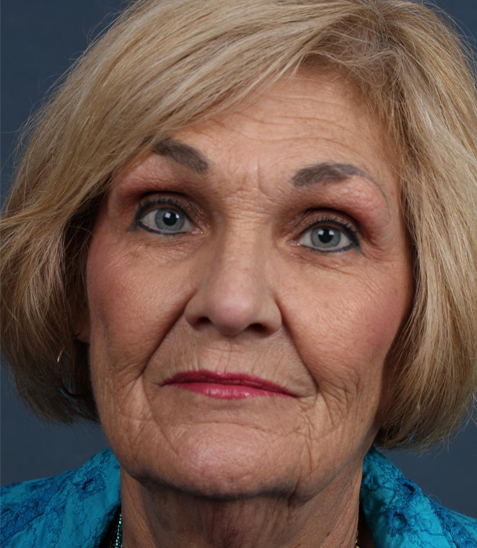 قبل-لیفت-صورت2