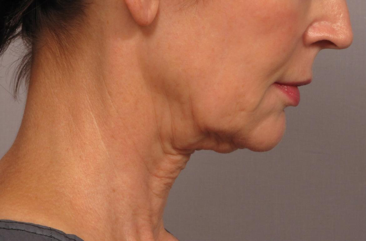 قبل-لیفت-گردن