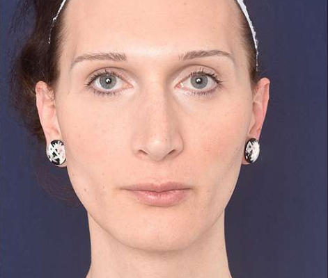 قبل-کوچک-کردن-چانه